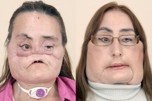 face-transplants face-transplants