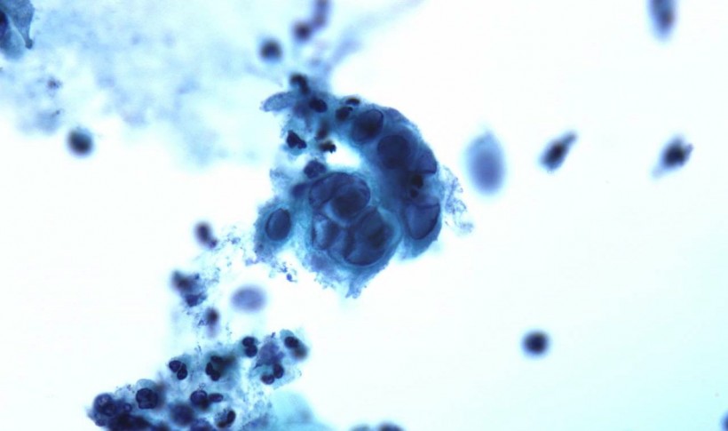 herpes